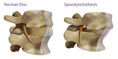 Listhesis spine - ealcberkeley.x.fc2.com