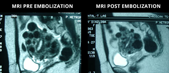 Impending fibroid expulsion on MRI after uterine fibroid embolization -  ScienceDirect