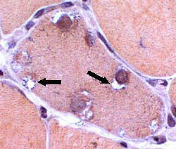 Vacuoles within muscle fiber