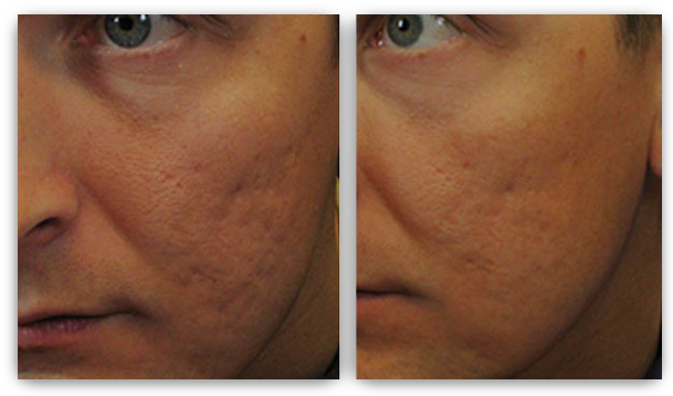 Laser Skin Rejuvenation