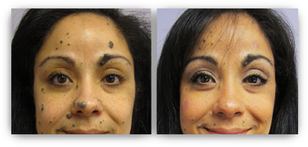 mole removal laser face skin minneapolis surgical non clinic rejuvenation treatment vary results skinrejuvenationclinic