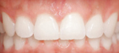 Fall in love with your smile with the help of our invisible braces.