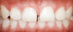 Our clear braces can enhance your smile like nothing else.