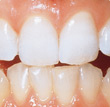 Your source for professional teeth whitening in Texarkana.