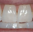 You'll love your new smile with professional teeth whitening.