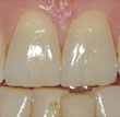 Enhance your smile with zoom whitening.