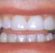 Smile confidently again with cosmetic dentistry.