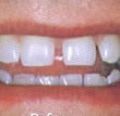 Get the smile you've always wanted with LUMINEERS